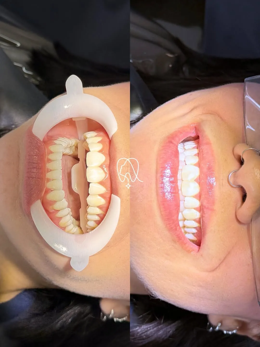 3 Mitos sobre Limpeza Dental