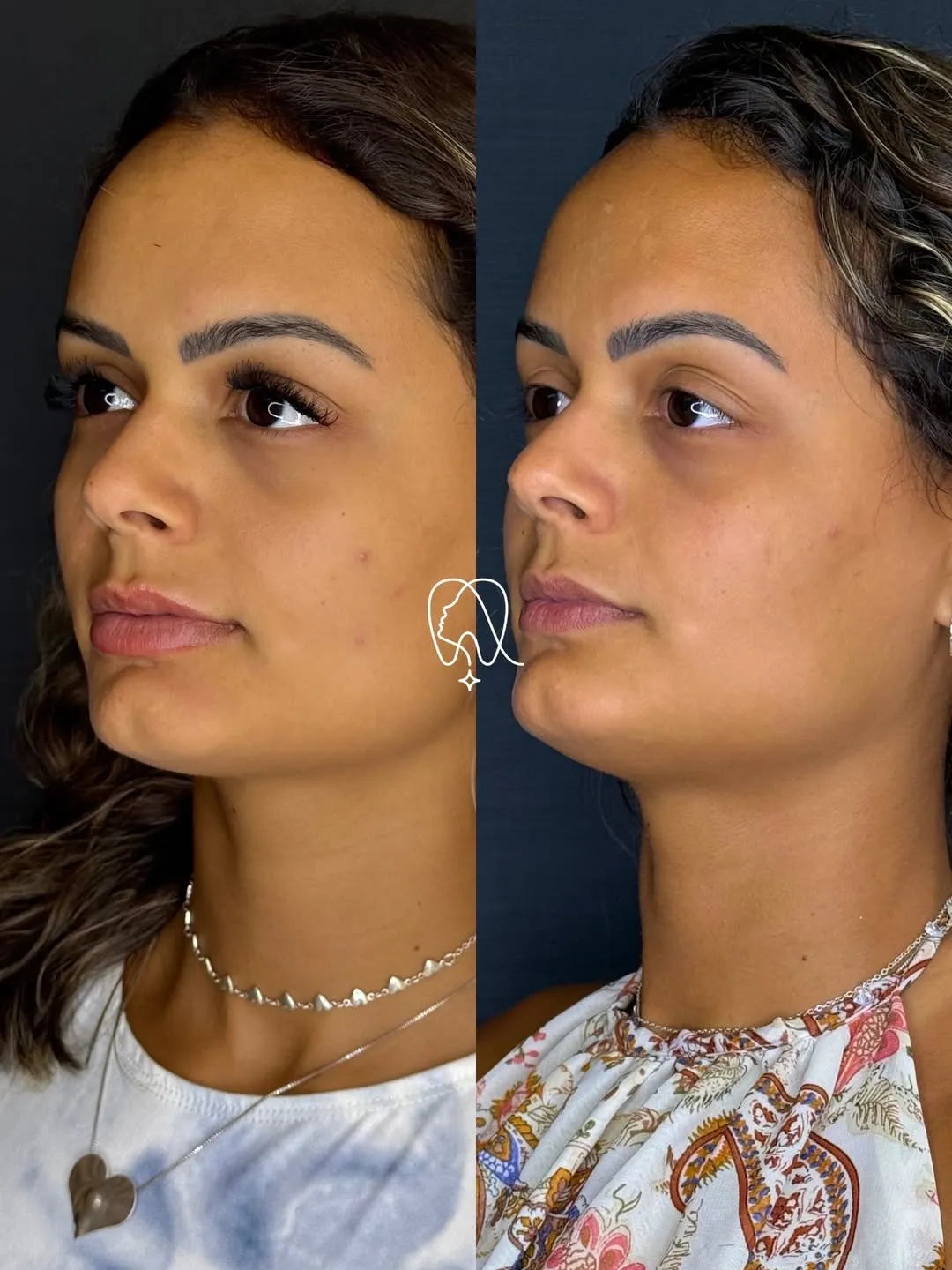 Quando começar Botox